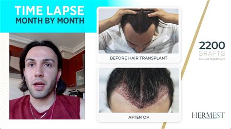 hermest hair transplant clinic review.